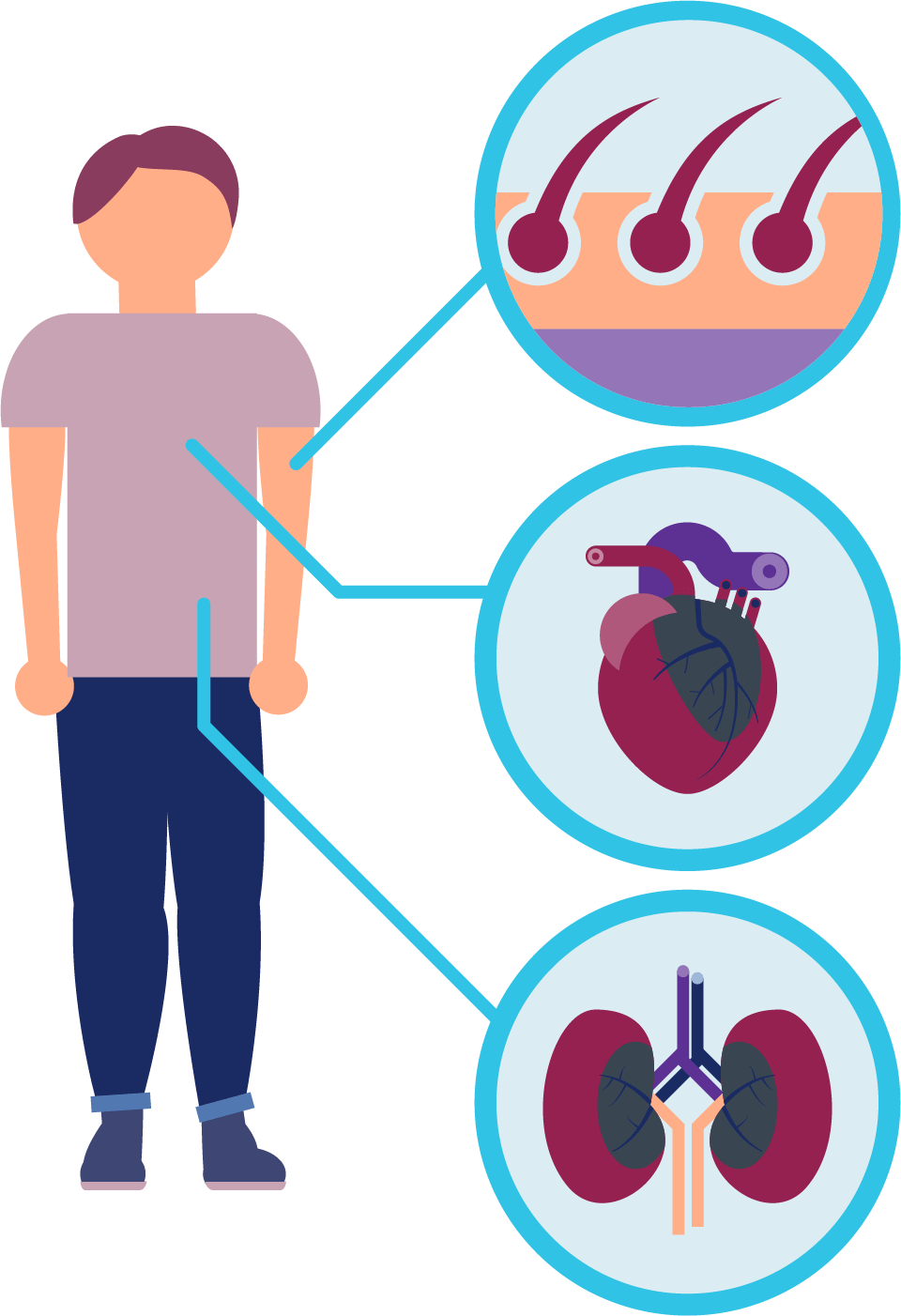 Signs and symptoms of Fabry disease